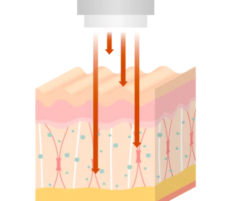 CO2프락셀